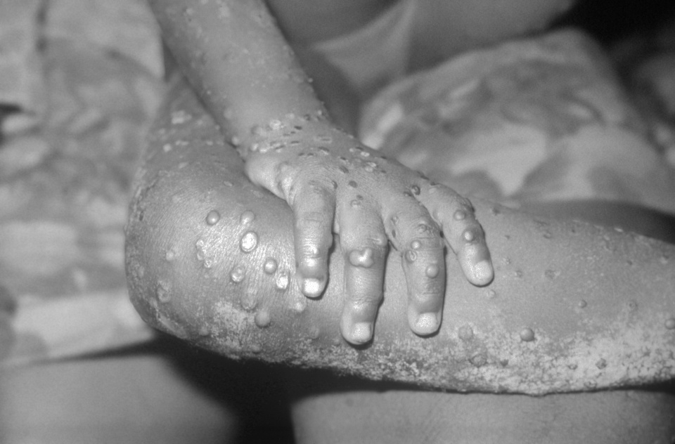 Schwarz-weiß-Foto von Armen und Beinen eines Kindes mit kleinen, wässrig gefüllten Pocken.